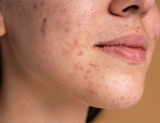 Acne & Scar Treatment OPD