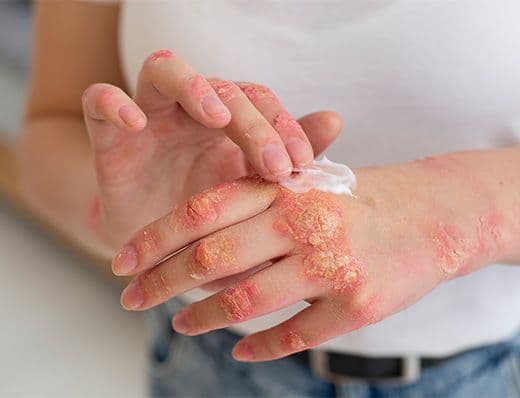 Psoriasis & Eczema Treatment OPD